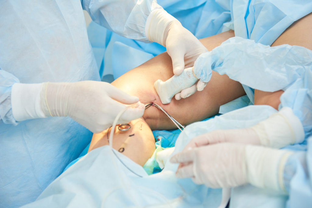 varicose vein treatment