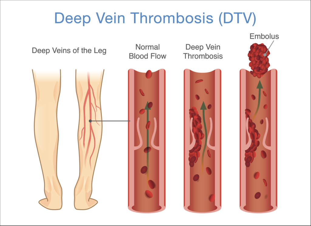 varicose veins and dvt