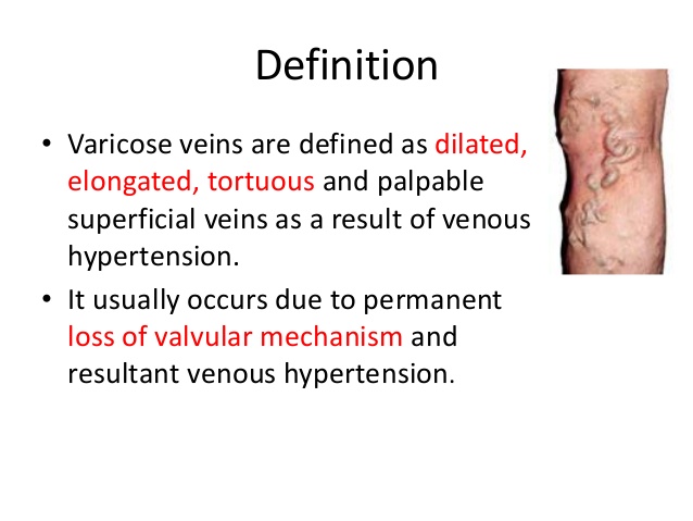 varicose vein definition grand junction