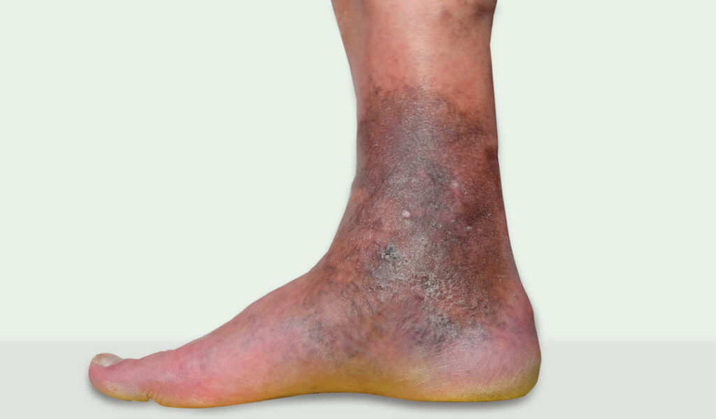 chronic veinous insufficiency in the lower leg