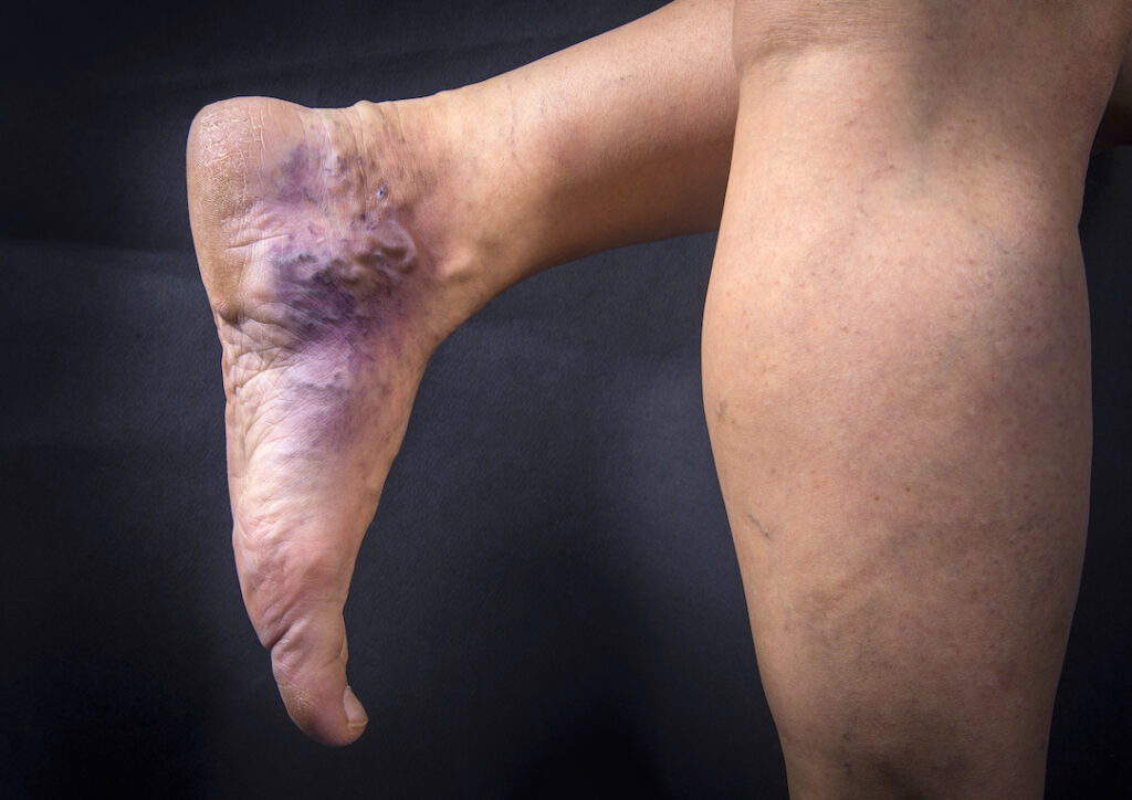 Human foot with varicose veins
