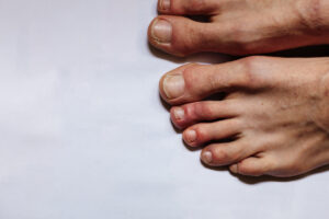 Covid-19 affects on veins