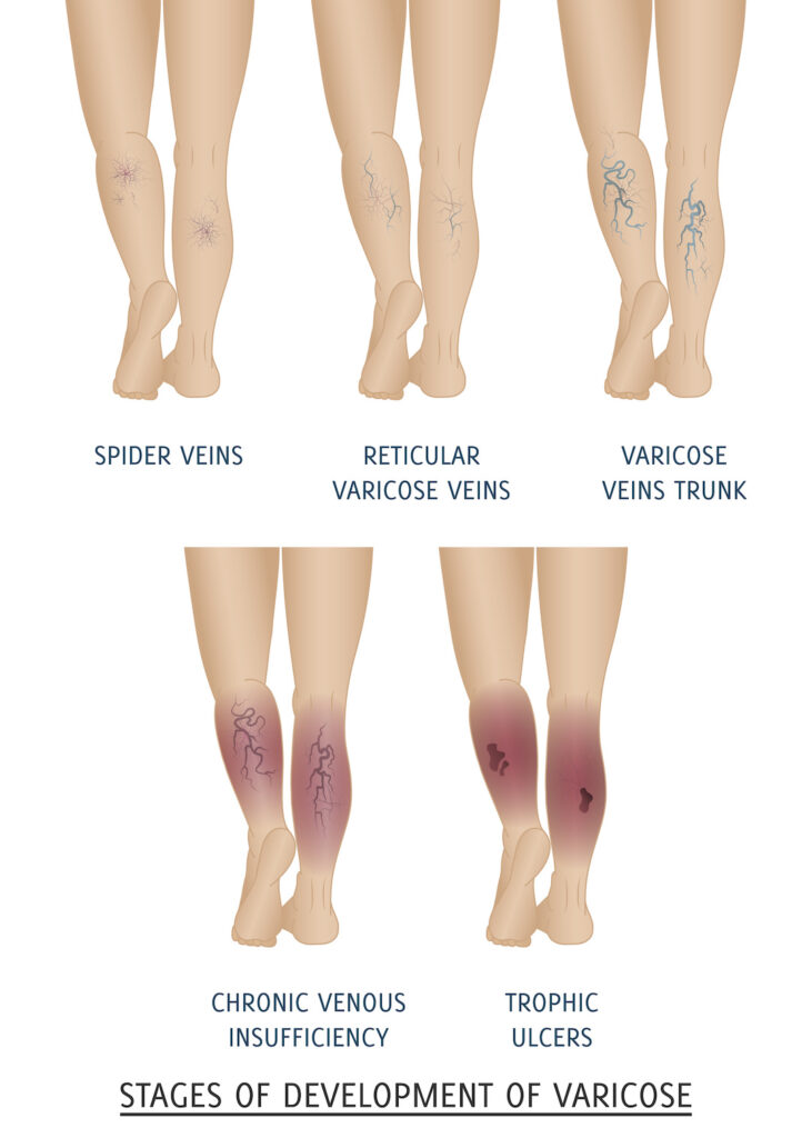 diagram of various vein conditions