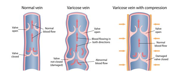 Diagram of varicose vein