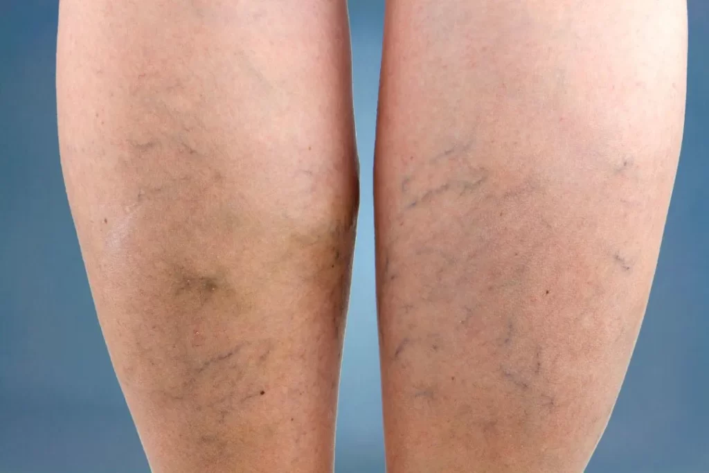 spider vein treatment near me